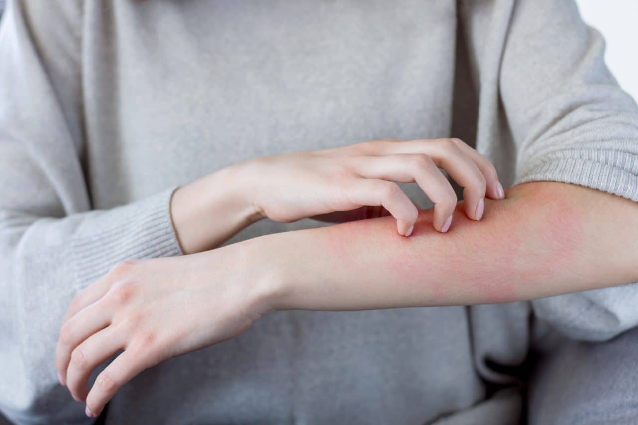 Woman scratching at a rash on her arm.