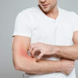 Man scratching a rash on his arm.