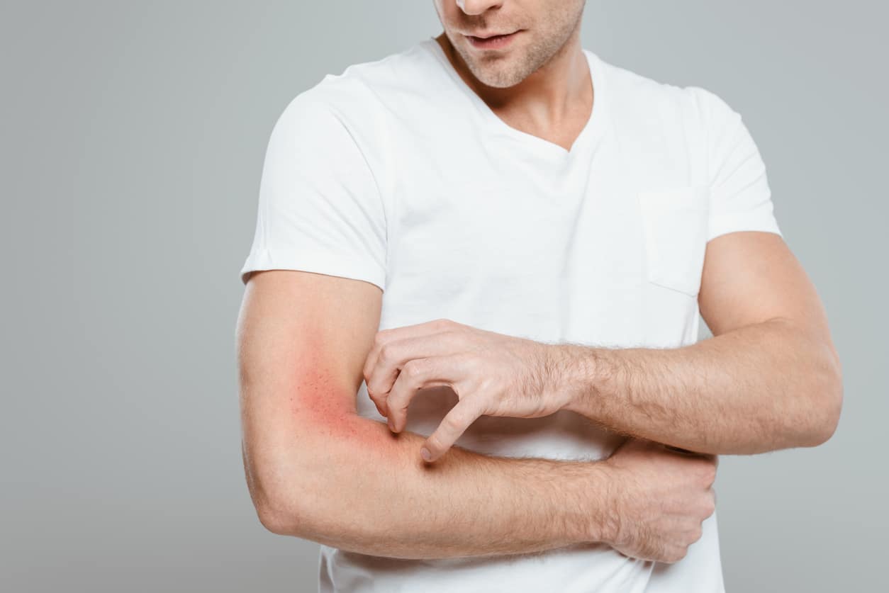 Man scratching a rash on his arm.