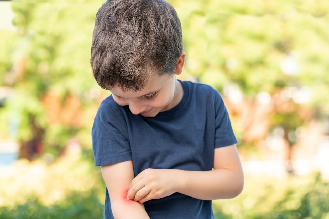 Child scratching and looking at his arm because it itches in a park with green background