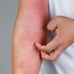 Close up of a person scratching a rash