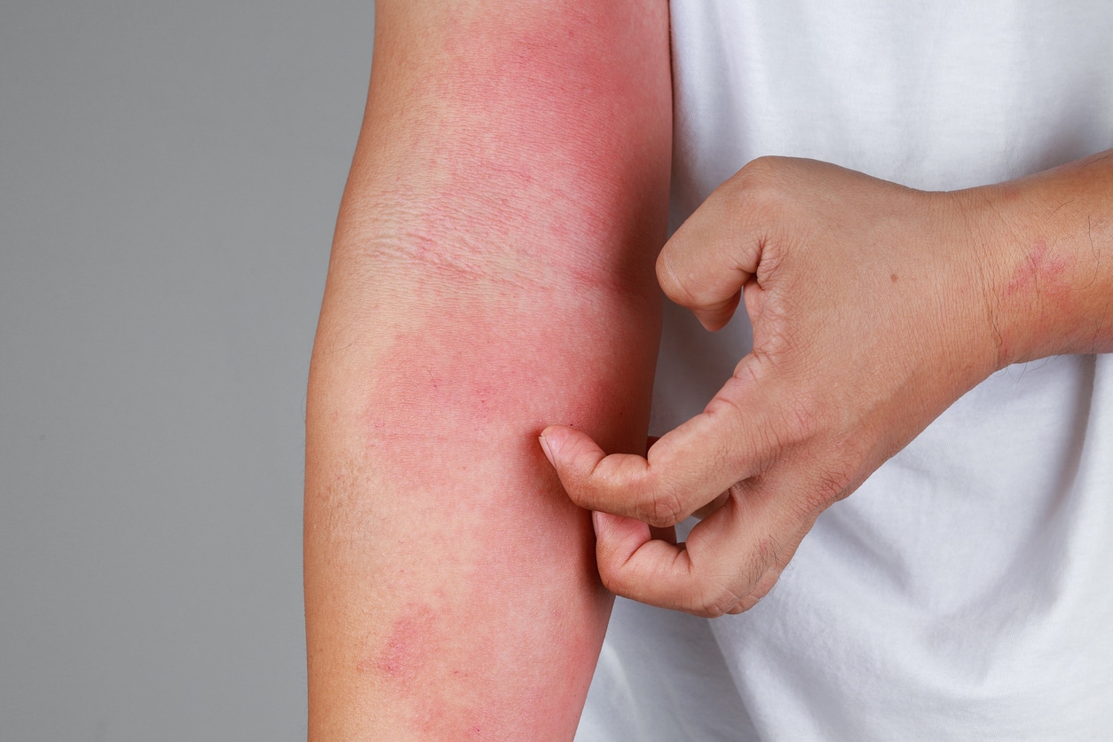 Close up of a person scratching a rash